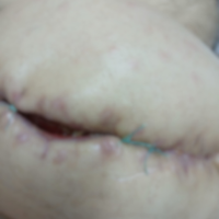 UPDATE 09.05.2025 – Lucian trece printr-o evoluție nefavorabilă post-operatorie